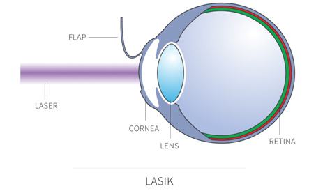 laser assisted in situ keratomileusis